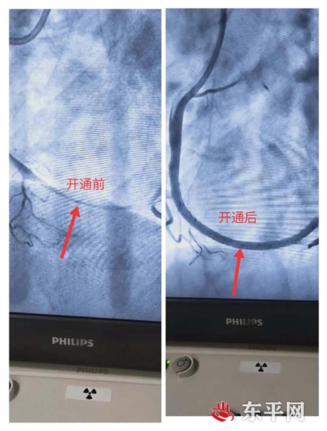 东平县人民医院成功救治自发性冠状动脉夹层患者 填补救治领域空白